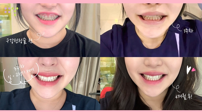  웃을 때 잇몸이 많이 보여 진행한 거미스마일 수술, 구강전정술 6개월 리얼 후기