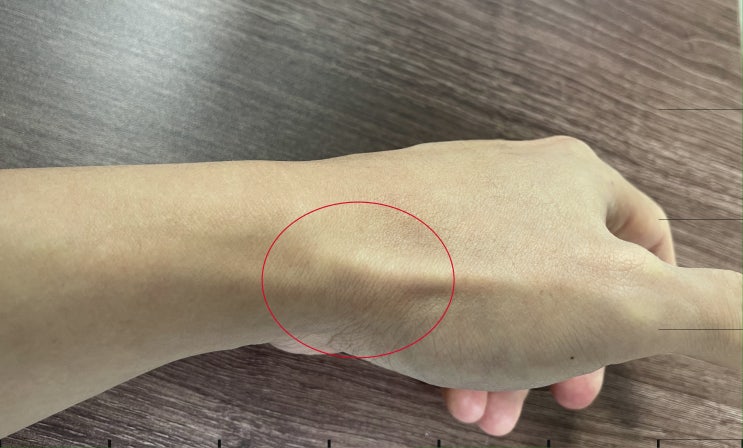  손녀 돌보다가 손목이 아파요/ 드퀘르뱅 건초염 (의사작성)