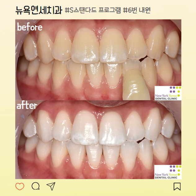 강남역치과 추천 치아미백 전후사진 비교