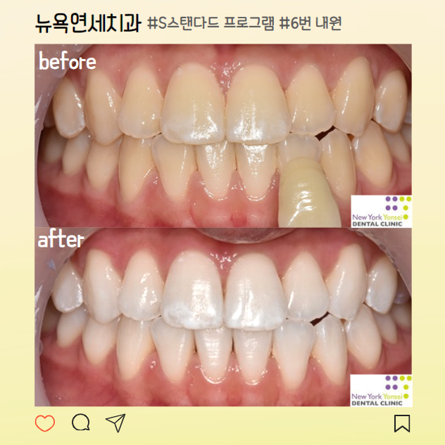  강남역치과 추천 치아미백 전후사진 비교