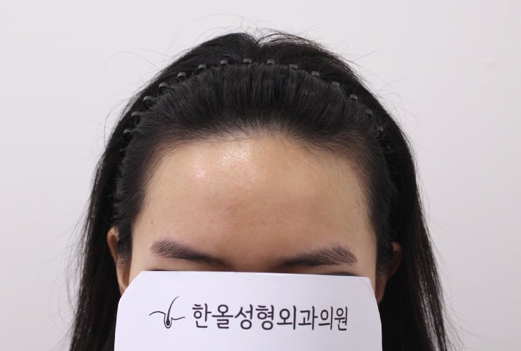  20대 여성 비절개 헤어라인 3500모 2주 경과