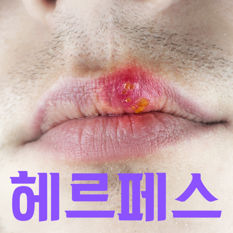  테스터 화장품을 통한 바이러스 헤르페스 입술 증상, 원인