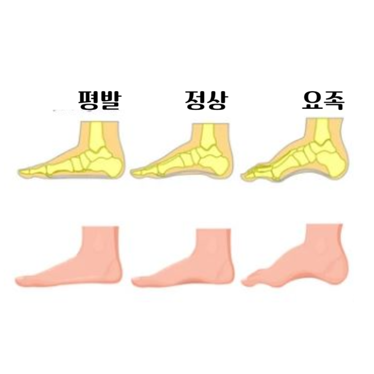  평발만큼 치명적인 요족 자가진단 합병증 교정운동