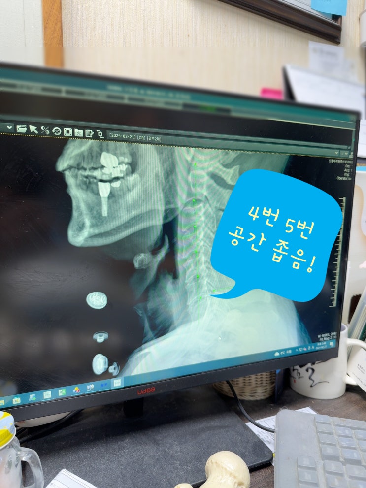 일자목디스크로 인한 경추상완증후군(팔과 손 무감각), 병원 치료와 실제 비용 일자목디스크로 인한 경추상완증후군(팔과 손 무감각), 병원 치료와 실제 비용
