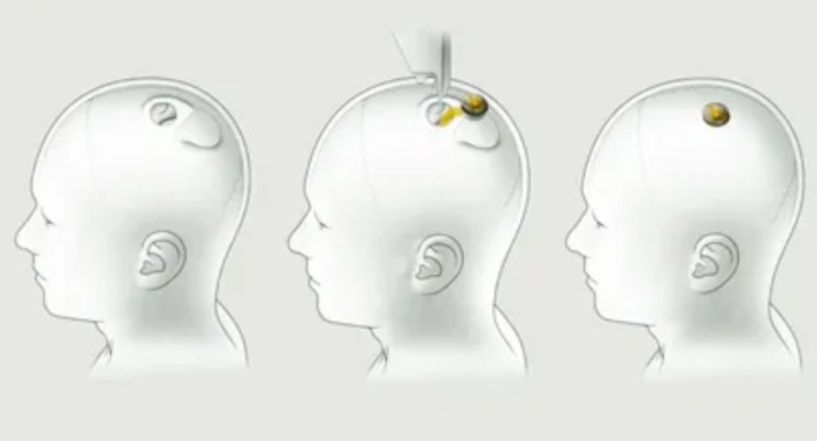 일론 머스크의 뉴럴링크, 뇌에 칩을 이식하여 컴퓨터 제어 성공