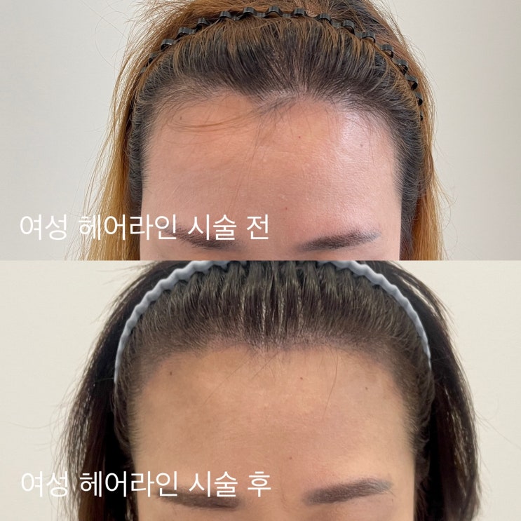  장기동 두피문신추천 필릭스스칼프