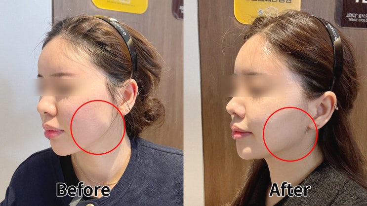 센텀 보톡스 후기만 보고 함부로 하시면 안 됩니다. 센텀 보톡스 후기만 보고 함부로 하시면 안 됩니다.