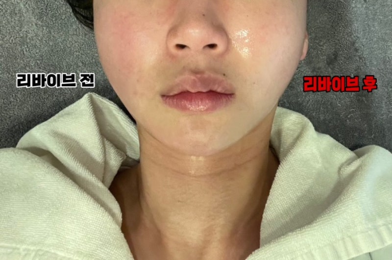 울산리프팅, 부작용을 예방하는 2가지 꿀팁 2