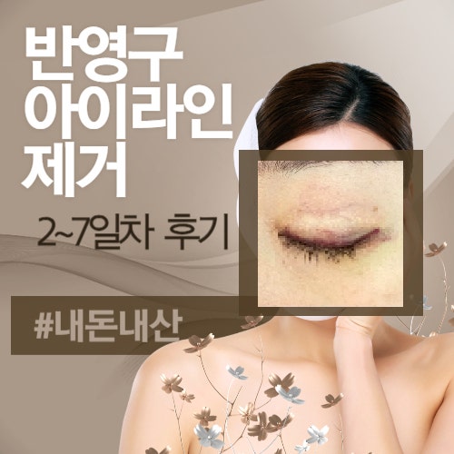  반영구 아이라인 제거 후기, 2일차~7일차 사진(붓기, 멍, 눈썹손상)
