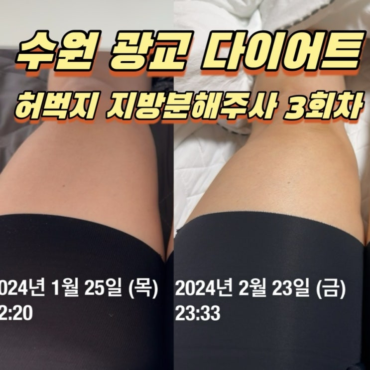  수원허벅지 다이어트병원, 하프컷 지방분해주사 3회차 눈바디 비교