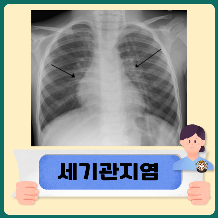  급성 세기관지염 증상 및 치료