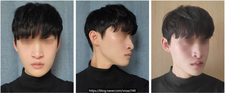  남성 무교정 양악, 윤곽3종 술후 경과 : 집도의가 들려주는 수술 후기 (1) orthognathic surgery with facial countouring
