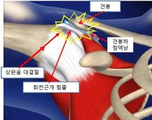 Shoulder Impingement Syndrome 1: How is your shoulder? (Causes and Symptoms) — 본문 그림