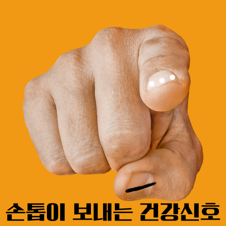  손톱 검은세로줄 흑색종과 구별하는 방법과 흰색점 원인, 영양제
