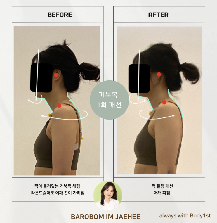  [김포 거북목] '바로봄체형교정운동센터' 거북목, 라운드숄더 교정 후기