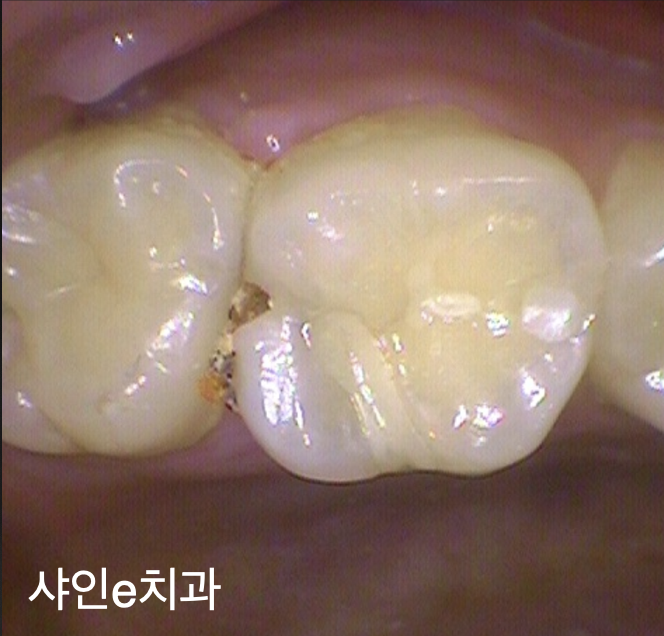  염창역 치과! 어금니 구멍,통증 치료의결정적 순간