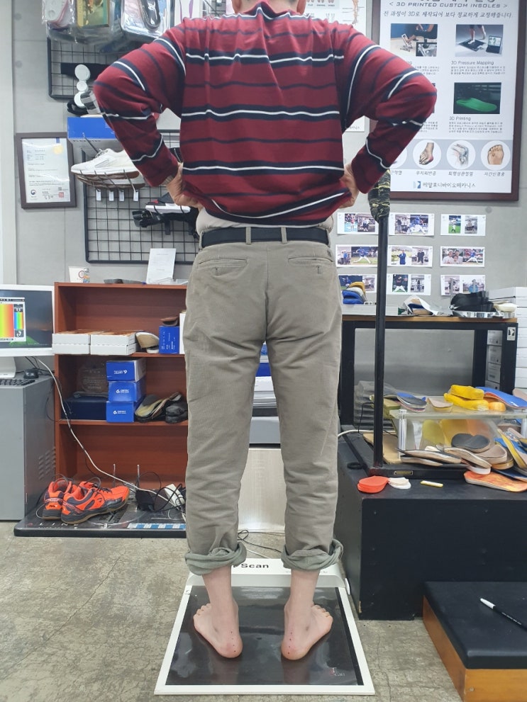  대퇴골 골절 후 망가진 걸음걸이, 어떻게 회복할까?