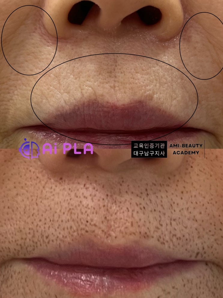  대구 탄력 주름 노화된피부 플라즈마 시술로 !탄력쫀쫀 피부완성!