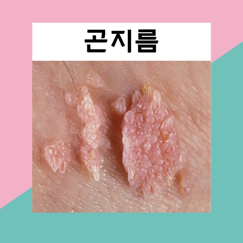 여성 곤지름 사진 여자 곤지름 증상(HPV 전염&예방법)