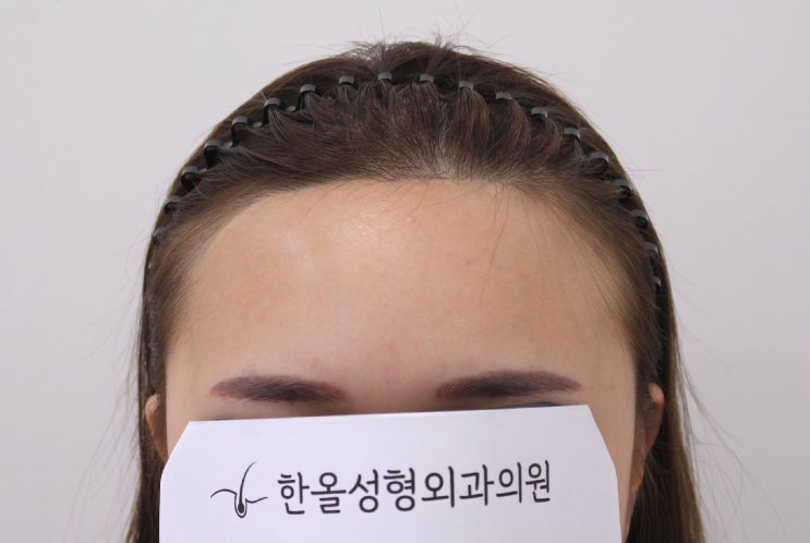  20대 여성 이마축소술 후 비절개 헤어라인 교정 2500모