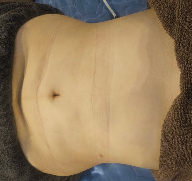  복부 지방흡입 통증 이 오래 지속되는 이유 2 가지