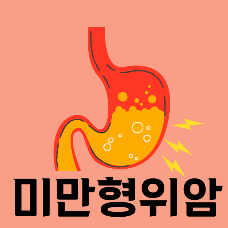  젊은 층에 발생하는 위암 1위 미만형위암의 모든 것