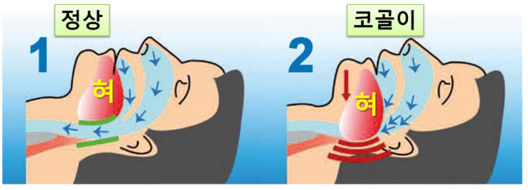  코골이의 원인과 만 원으로 고치는 법 - 양압기 없이 코골이 방지 기구로 수면무호흡 증상 치료한 후기