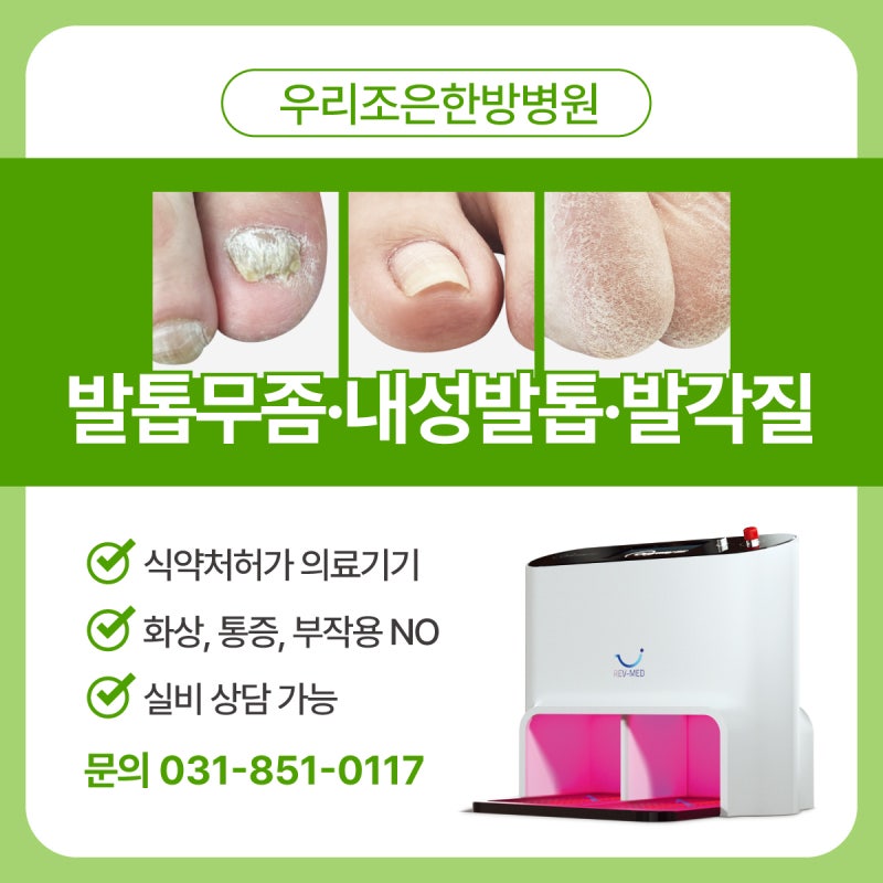 의정부 발톱무좀 예방법과 레이저치료