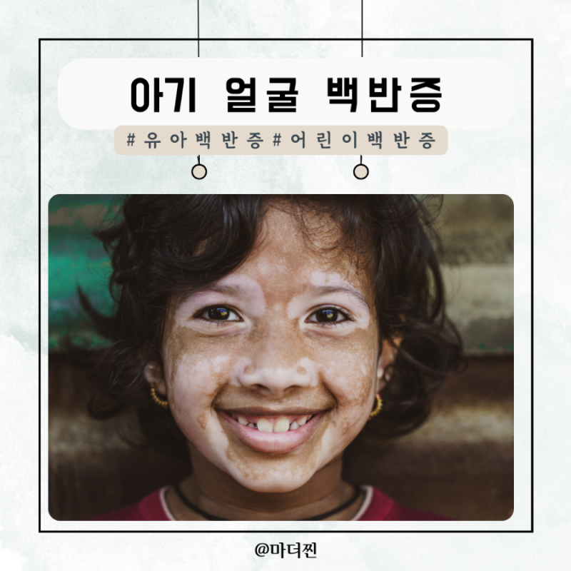 아기 얼굴 백반증 원인 증상 치료방법