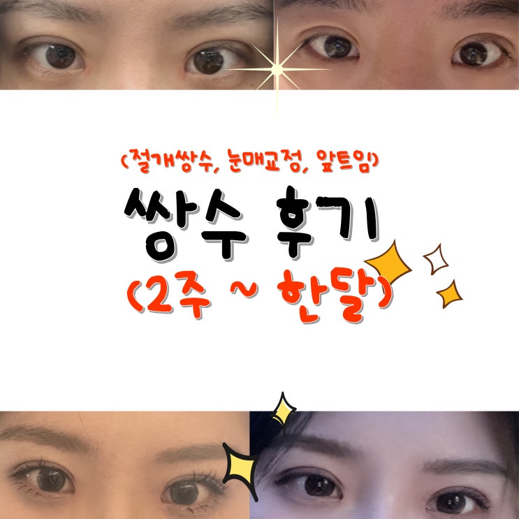  [절개재수술, 눈매교정, 앞트임] 쌍수 후기 : 2주~한달간의 기록