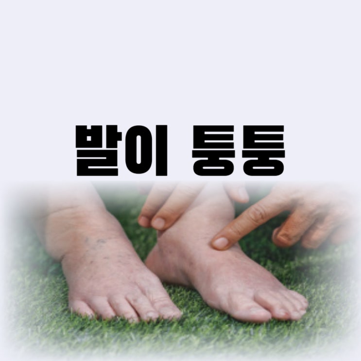 발이 퉁퉁 붓는 이유 발 붓기 빼기 방법 2가지