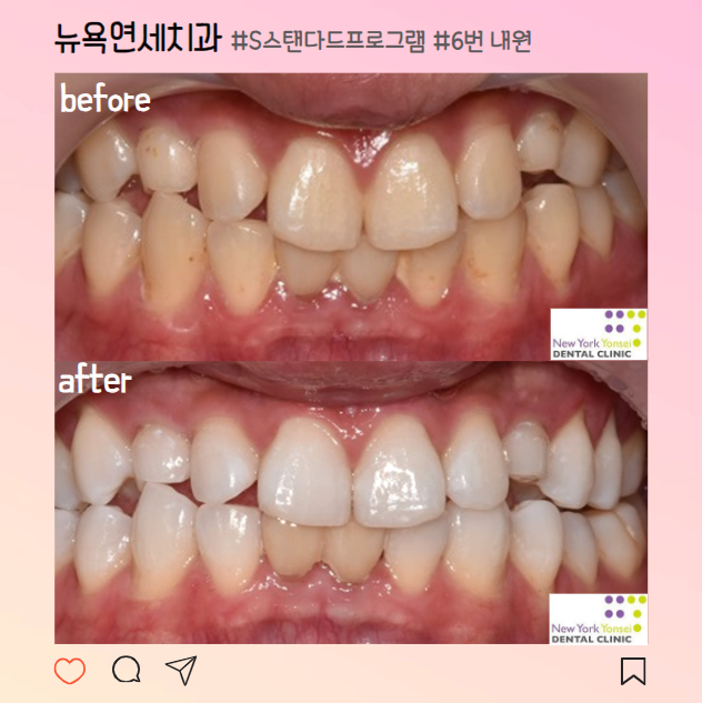  강남역치아미백 전문 치과에서 누런이빨 하얗게