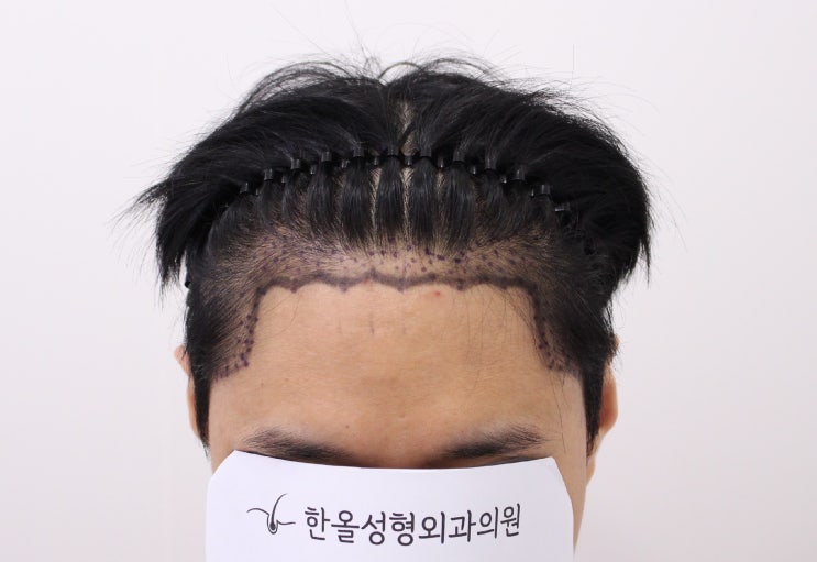  30대 남성 헤어라인 비절개 2500모 2주 경과