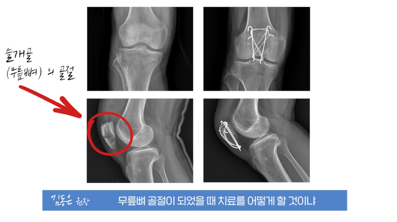 뼈 골절 때 빨리 치유하는 방법? 좋은 음식, jjimjil 뼈 골절 때 빨리 치유하는 방법? 좋은 음식, jjimjil