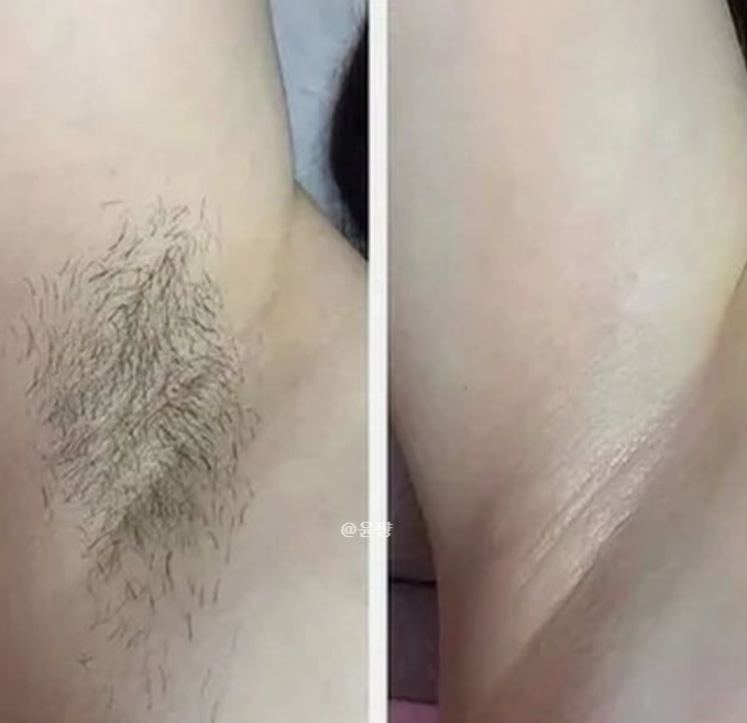  겨드랑이 털 제모방법 털뽑기 피부과 레이저제모 장단점