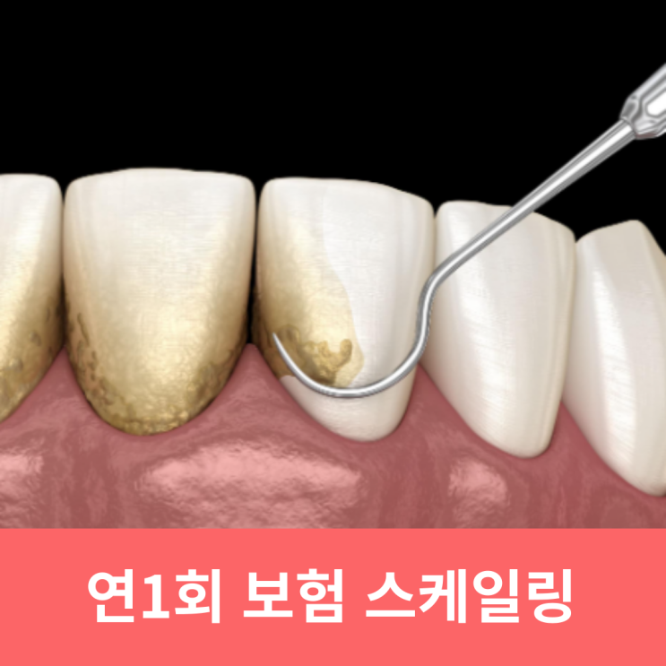  치과 보험 스케일링 제대로 알고 하자 나이와 비용, 주기 (치석제거)