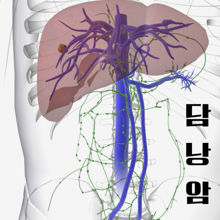  오른쪽 옆구리 통증 담낭암 증상일 수도 있다.