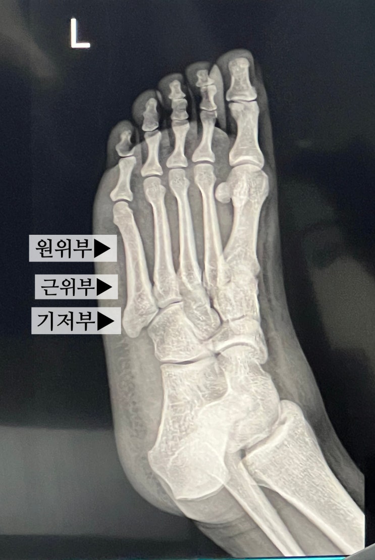  발가락골절 제5번 중족골은 어디? 골절이 의심된다면 치료방법과 기간은