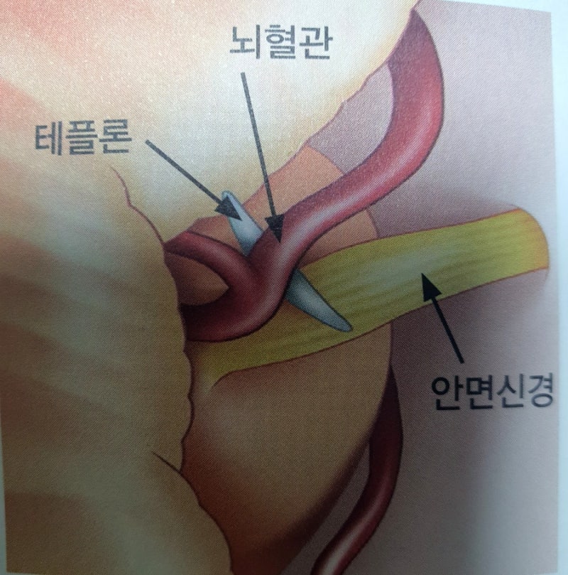 미세혈관감압술 2