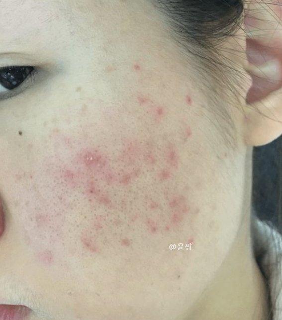  붉은 아픈 여드름 염증 주사 가격 부작용 알아보자