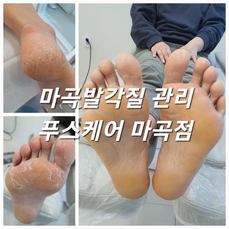  마곡발각질 관리 푸스케어 마곡점 굳은살, 각질제거로 맨질맨질~