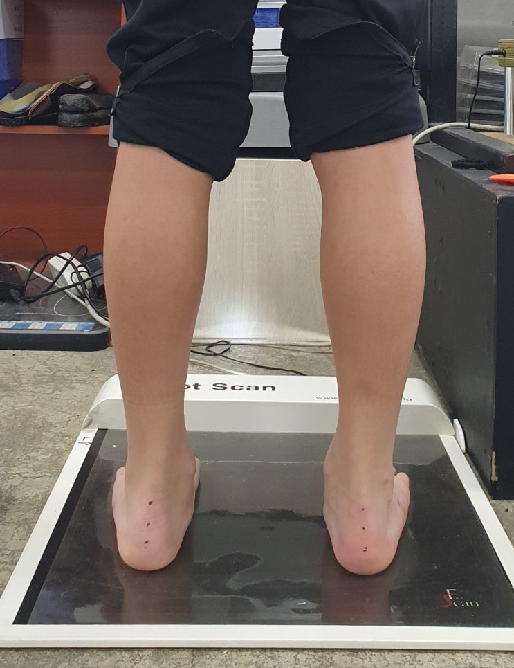  축구 선수의 발목 통증, 족궁(발아치)만 올리면 해결될까?