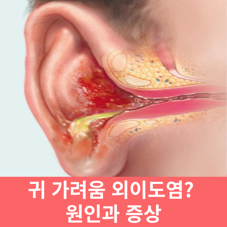  귀 가려움 외이도염 아닐까 원인과 증상 알아보기