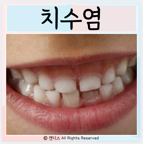 치수염 원인 증상 통증 치아손상 충치 치료예방