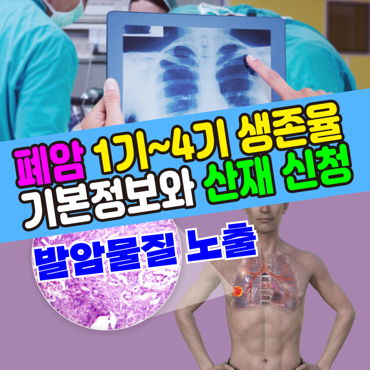  [건강기본정보] 폐암 진단(1,2,3,4기) 생존율과 산재보험 신청