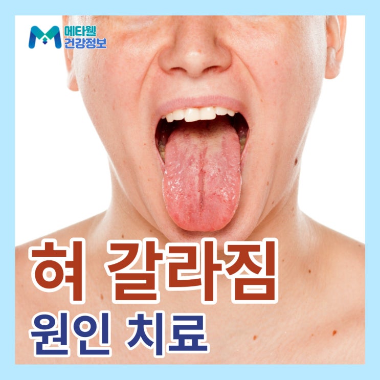 혀갈라짐 원인, 혓바닥 갈라짐 건강상태, 혀 통증 치료, 병원