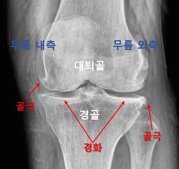  화순 정형외과, 무릎 퇴행성관절염 차도가 없다면?
