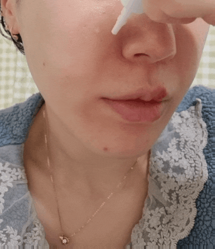  [내돈내산]바이오힐 보 프로바이오덤 99.9 멜팅콜라겐 팔자 & 앞볼 필름 전후 비교 진지리뷰