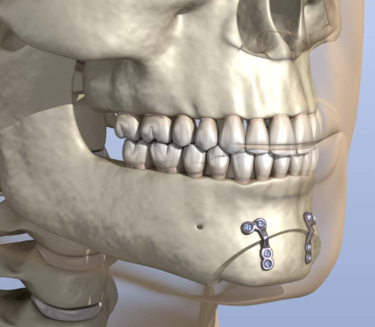 교정치료 후 턱끝 수술로 옆모습을 훨씬 조화롭게 - 이부성형술, 턱끝성형 언제?