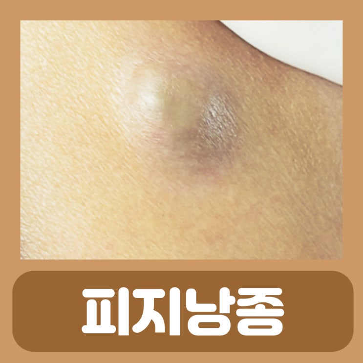  피지낭종 수술 후 제거 후기 발바닥 두피 겨드랑이 피지낭종 원인